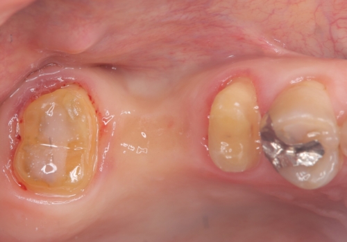 奥歯の奥側からよく汚れが出てくるの治療中