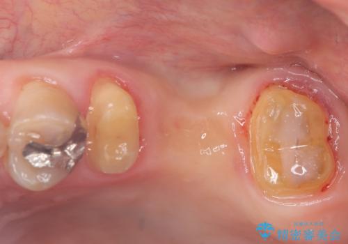 【セラミッククラウン】【ブリッジ】奥歯の奥側からよく汚れが出てくるの治療中
