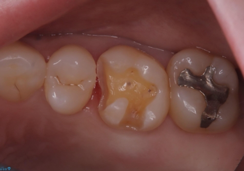 詰め物と歯の境目に汚れが溜まるの治療中