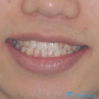 前歯のデコボコとクロスバイト インビザライン矯正治療の治療前(顔貌)