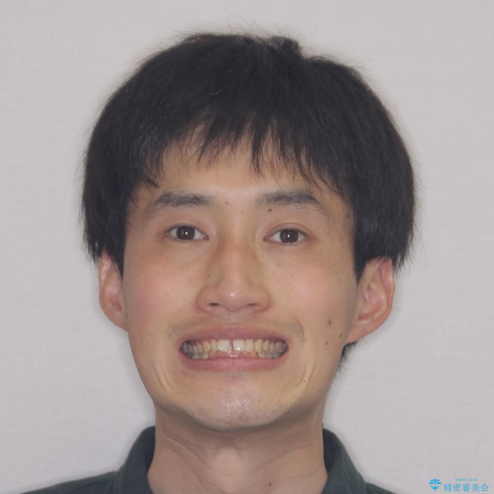【モニター】前歯に隙間ができるほどのディープバイト ワイヤー装置で負担の少ない咬み合わせにの治療前(顔貌)