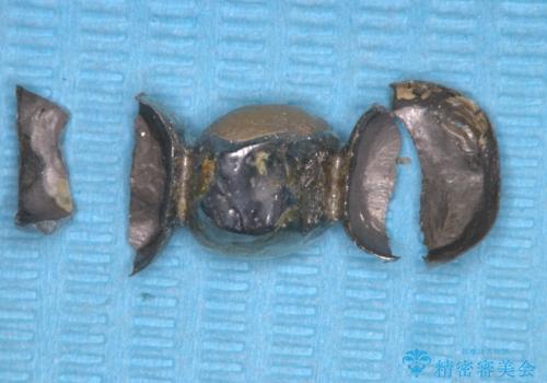 【セラミッククラウン】【ブリッジ】奥歯の奥側からよく汚れが出てくるの治療中
