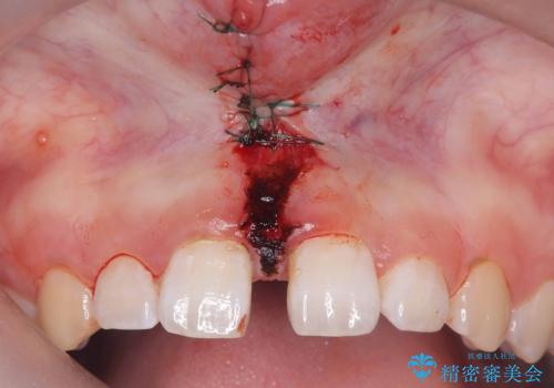 【上唇小帯切除術】子どもの頃から上の前歯の歯茎が気になってた!の治療中