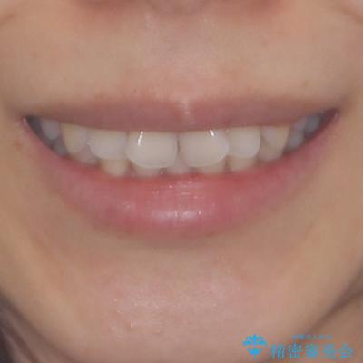 捻れた前歯をインビザラインで整えるの治療前(顔貌)