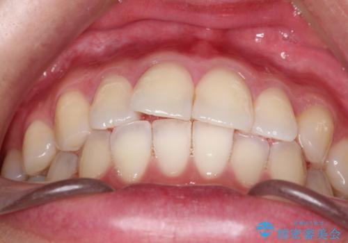 【ワイヤー矯正】軽度の叢生の治療前