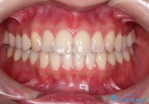 【ワイヤー矯正】軽度の叢生の治療前