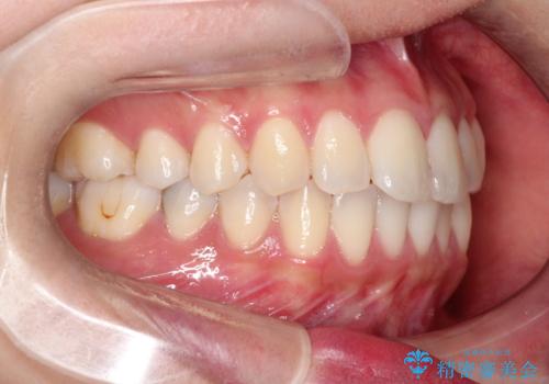 【ワイヤー矯正】軽度の叢生の治療前