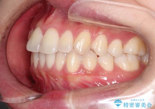 【ワイヤー矯正】軽度の叢生の治療前