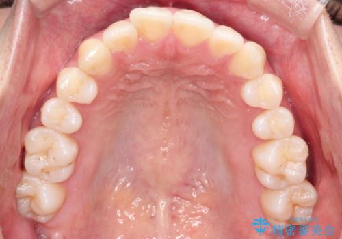 【ワイヤー矯正】軽度の叢生の治療前