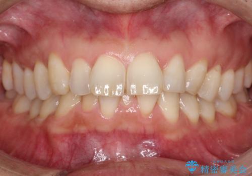 【インザライン】前歯の凸凹を治したいの症例 治療前