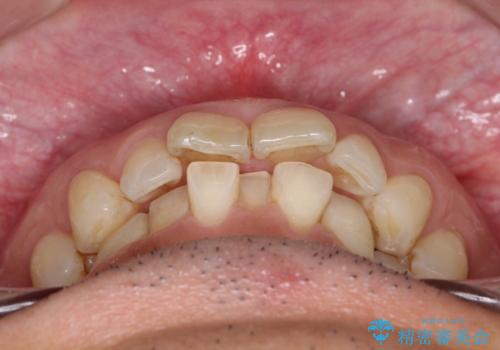 【インザライン】前歯の凸凹を治したいの治療前