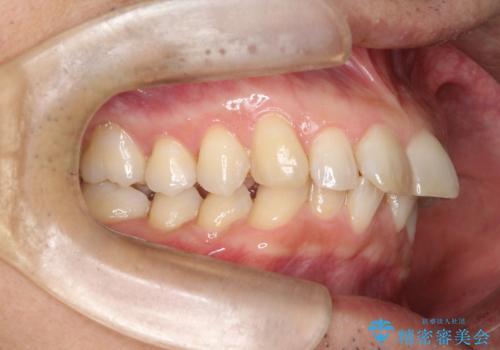 【インザライン】前歯の凸凹を治したいの治療前