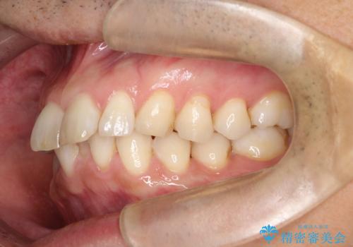 【インザライン】前歯の凸凹を治したいの治療前