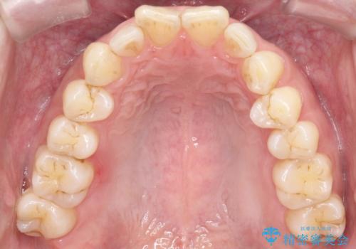 【インザライン】前歯の凸凹を治したいの治療前