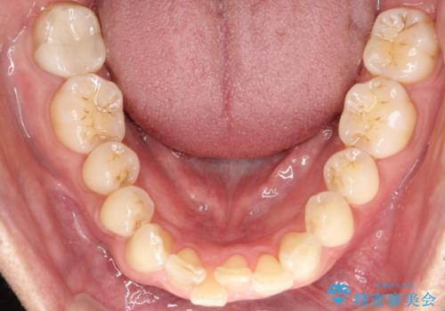 【インザライン】前歯の凸凹を治したいの治療前