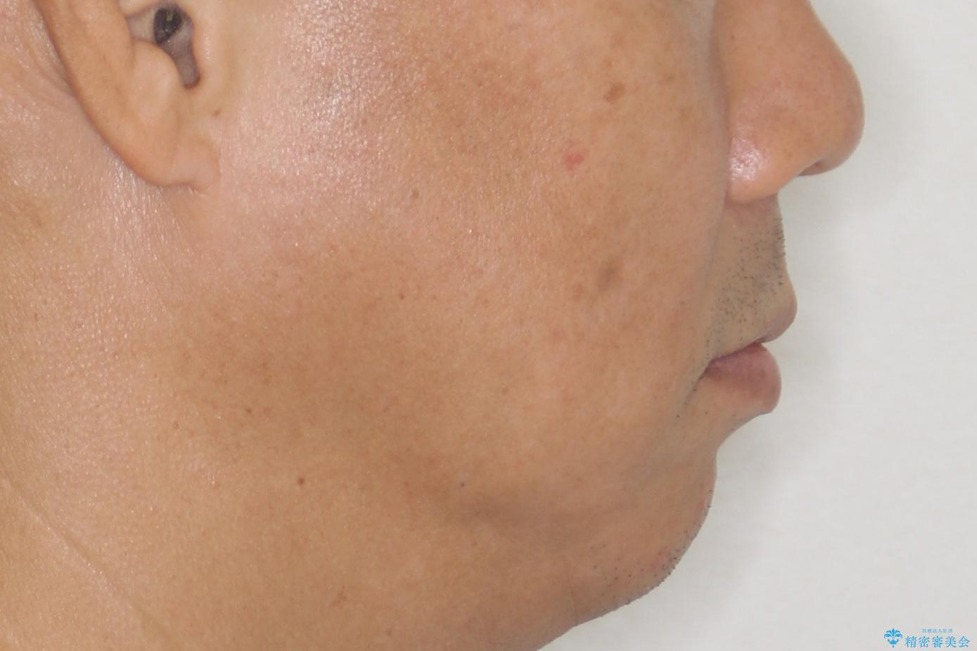 【インザライン】前歯の凸凹を治したいの治療前(顔貌)