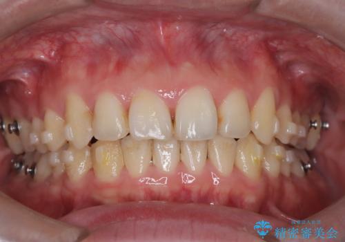 【インビザライン】前歯が出ているのを治したいの治療中