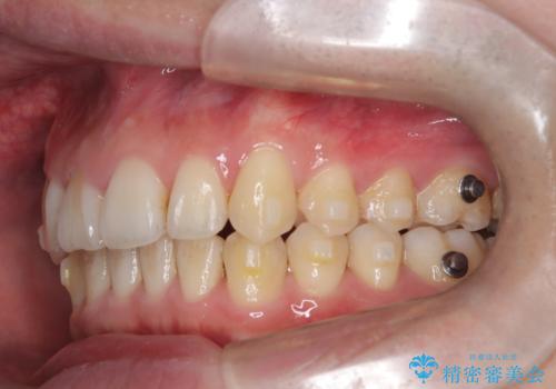 【インビザライン】前歯が出ているのを治したいの治療中