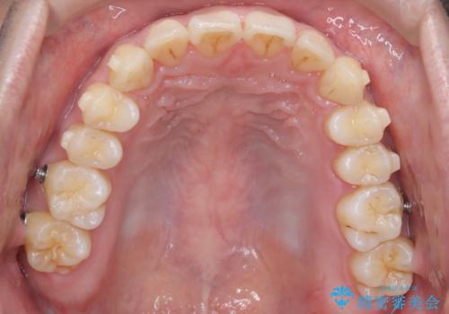 【インビザライン】前歯が出ているのを治したいの治療中