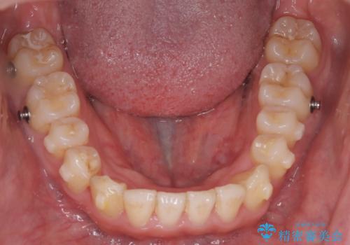 【インビザライン】前歯が出ているのを治したいの治療中