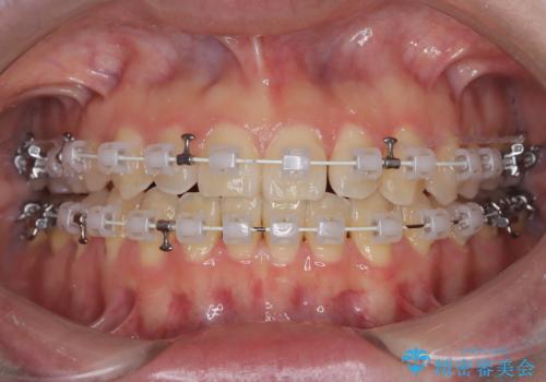【ワイヤー矯正】一番後ろの奥歯でしか噛んでいないかみ合わせを治したいの治療中