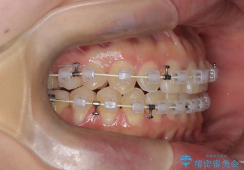 【ワイヤー矯正】一番後ろの奥歯でしか噛んでいないかみ合わせを治したいの治療中