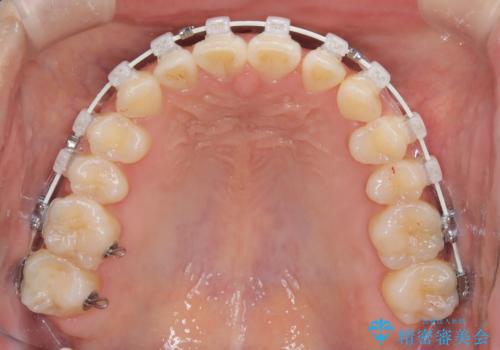 【ワイヤー矯正】一番後ろの奥歯でしか噛んでいないかみ合わせを治したいの治療中