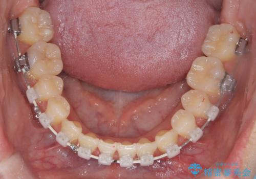 【ワイヤー矯正】一番後ろの奥歯でしか噛んでいないかみ合わせを治したいの治療中