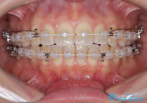 【ワイヤー矯正】軽度の叢生の治療中