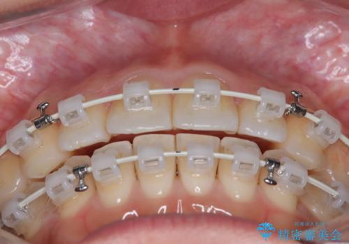 【ワイヤー矯正】軽度の叢生の治療中