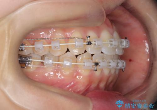【ワイヤー矯正】軽度の叢生の治療中