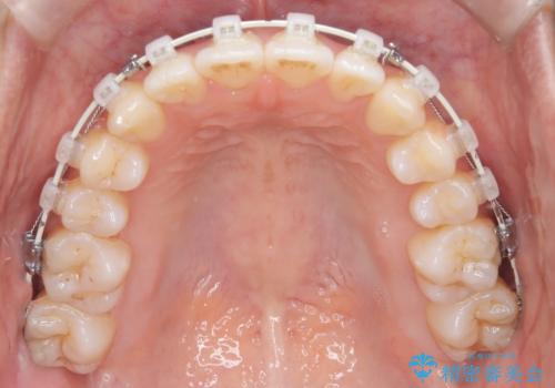 【ワイヤー矯正】軽度の叢生の治療中