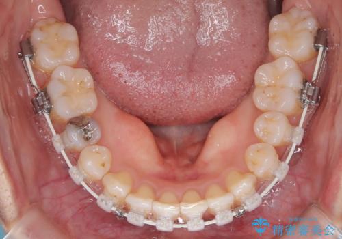 【ワイヤー矯正】軽度の叢生の治療中