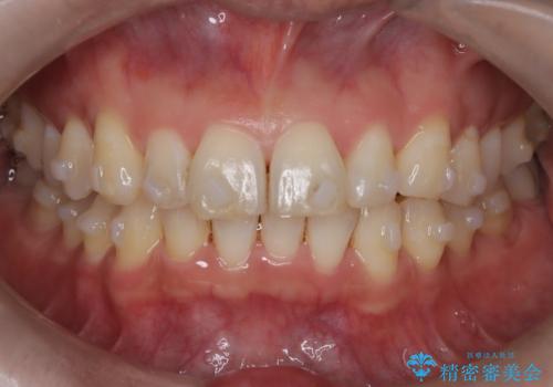 【インザライン】前歯の凸凹を治したいの治療中