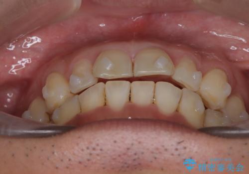 【インザライン】前歯の凸凹を治したいの治療中