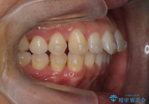 【インザライン】前歯の凸凹を治したいの治療中