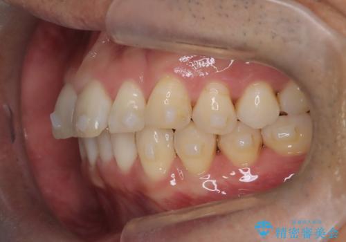 【インザライン】前歯の凸凹を治したいの治療中