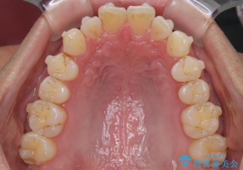 【インザライン】前歯の凸凹を治したいの治療中