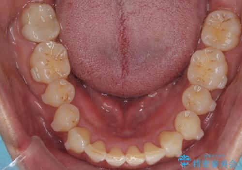 【インザライン】前歯の凸凹を治したいの治療中