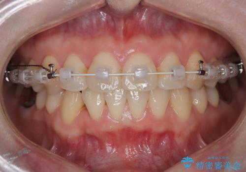 【ワイヤー矯正】がたつきを治したいの治療中