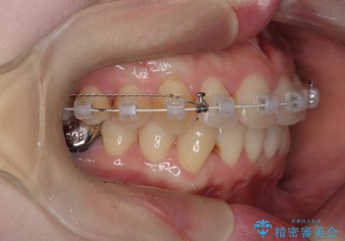 【ワイヤー矯正】がたつきを治したいの治療中
