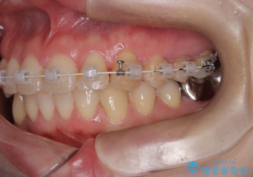 【ワイヤー矯正】がたつきを治したいの治療中