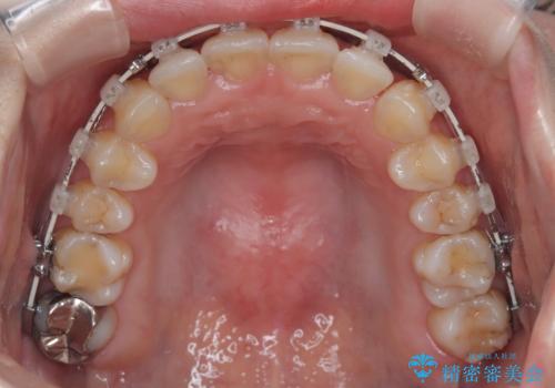 【ワイヤー矯正】がたつきを治したいの治療中