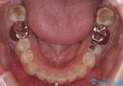 【ワイヤー矯正】がたつきを治したいの治療中