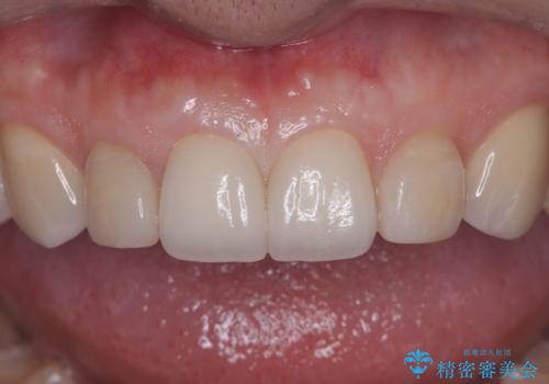 【セラミッククラウン】他院で治療したセラミッククラウンをやりかえたいの治療後