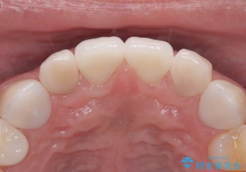 【セラミッククラウン】他院で治療したセラミッククラウンをやりかえたいの治療後