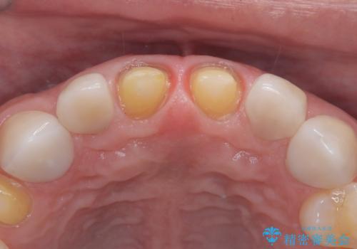 【セラミッククラウン】他院で治療したセラミッククラウンをやりかえたいの治療中