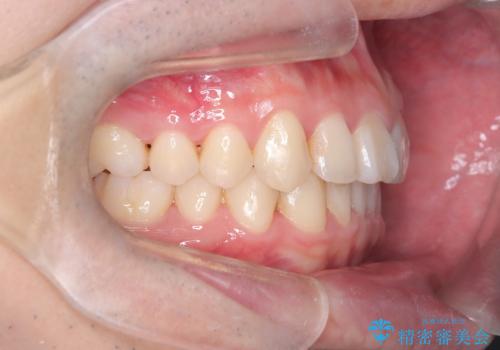 【インビザライン】前歯が出ているのを治したいの治療後