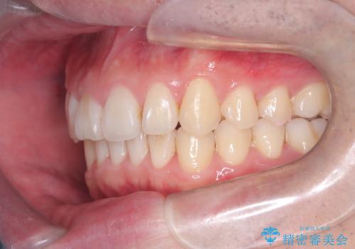 【インビザライン】前歯が出ているのを治したいの治療後