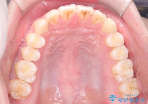 【インビザライン】前歯が出ているのを治したいの治療後